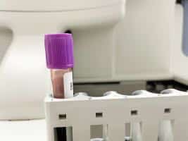 MBMD anaemia blood test, low Ferritin, iron deficiency MBMD